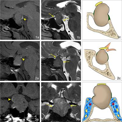 Diagnostic value of magnetic resonance imaging ectopic posterior pituitary hyperintense signal in pituitary macroadenoma